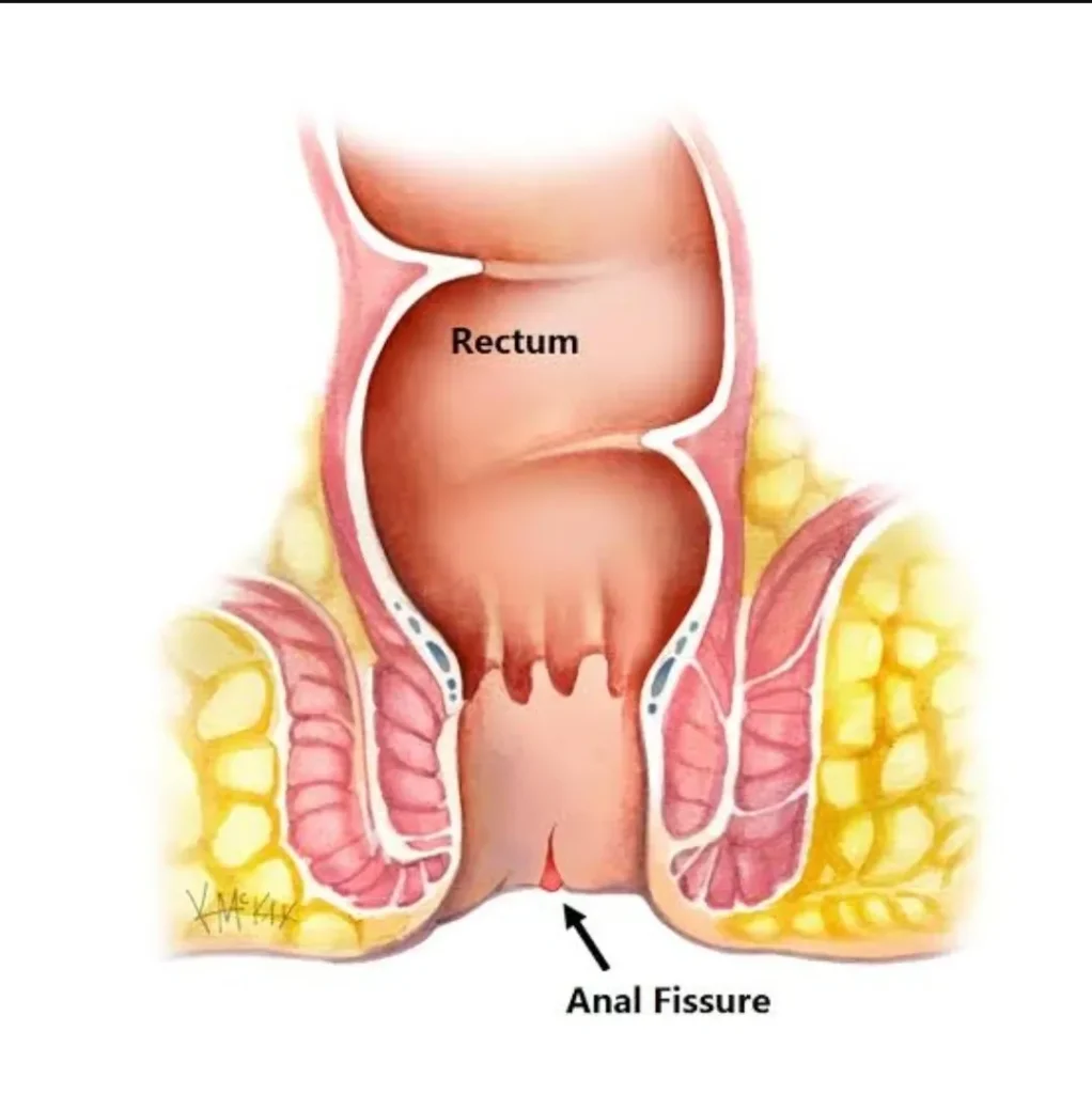 Fissure