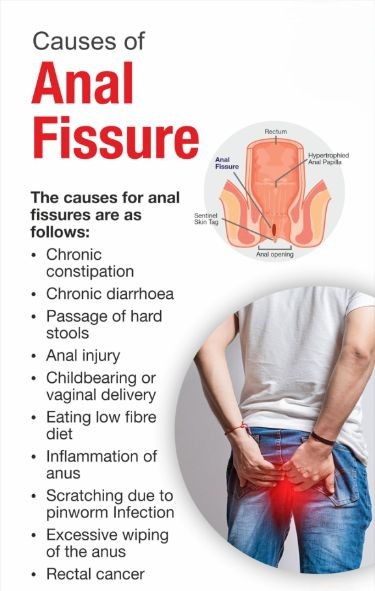 Fissure
