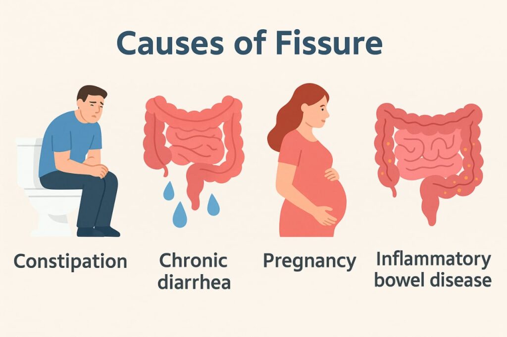 How to heal a fissure fast