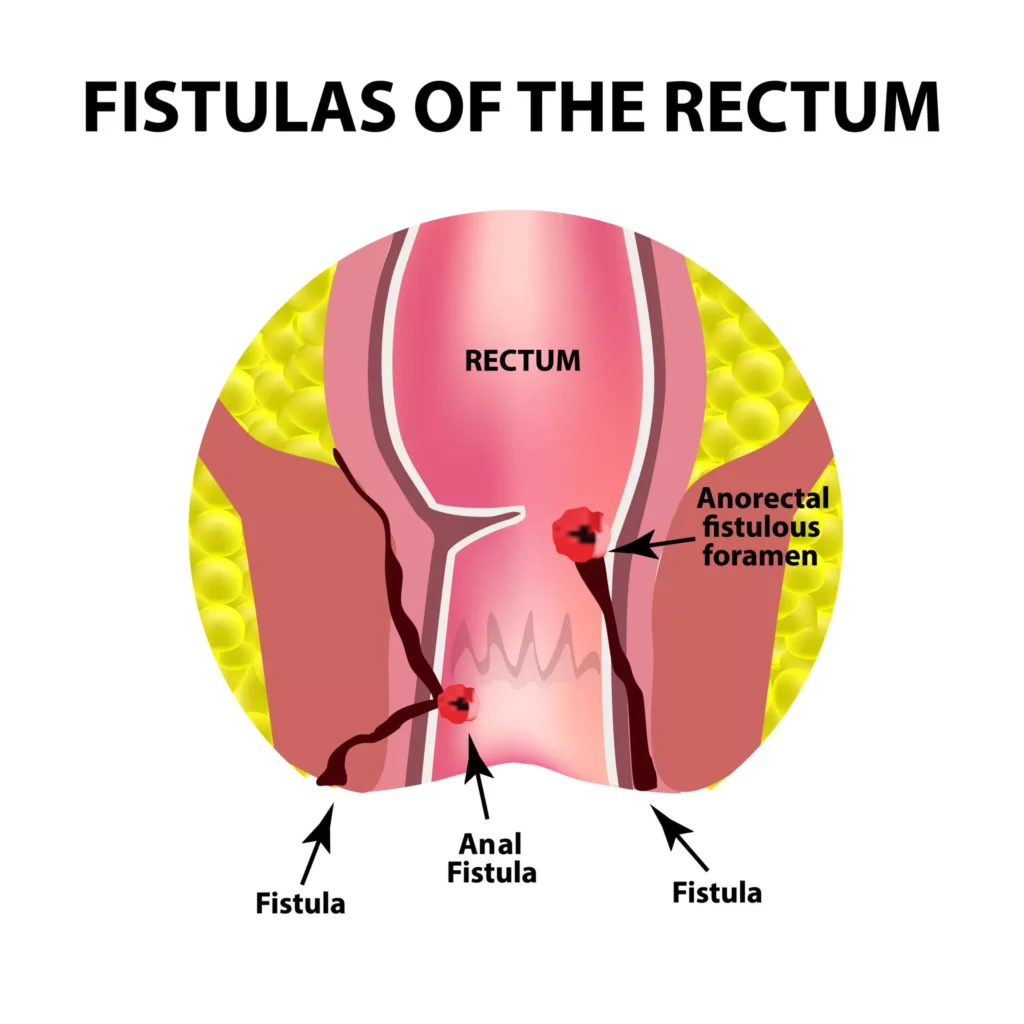 fistula kya hota hai