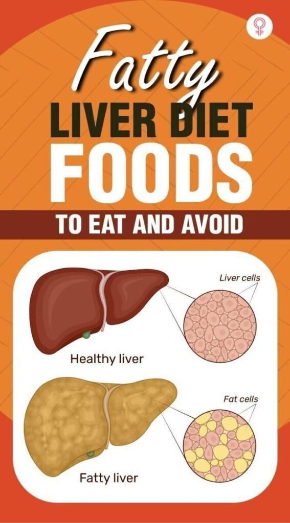 Grade 1 fatty liver