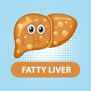 Grade 1 fatty liver